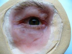 prothèse oculaire Charleroi prothèse oculaire Charleroi