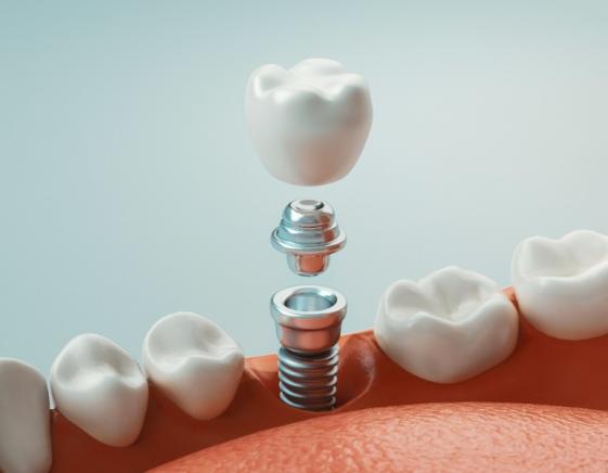 implants dentaires sur-mesure